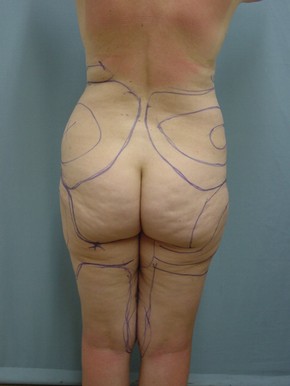 Liposuction