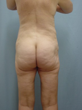 Liposuction