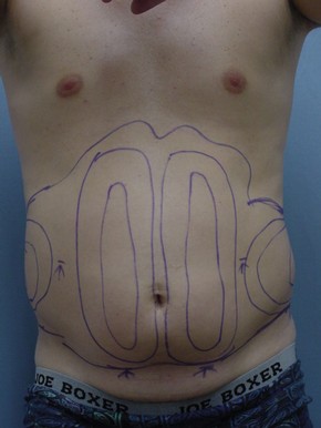 Liposuction