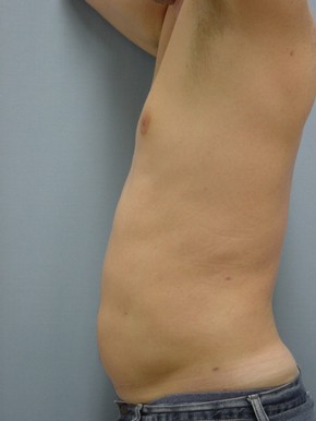 Liposuction