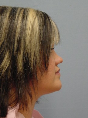 Liposuction