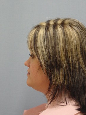 Liposuction