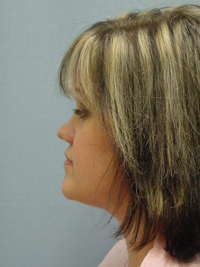 Liposuction