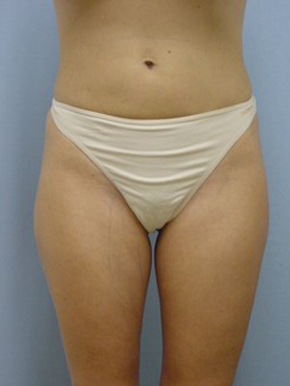 Liposuction
