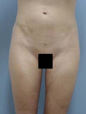 Liposuction