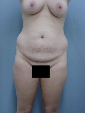 Tummy Tuck-Panniculectomy