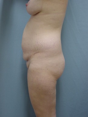 Tummy Tuck-Panniculectomy