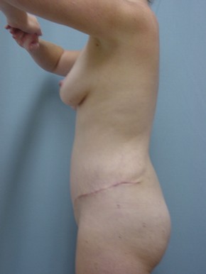 Tummy Tuck-Panniculectomy