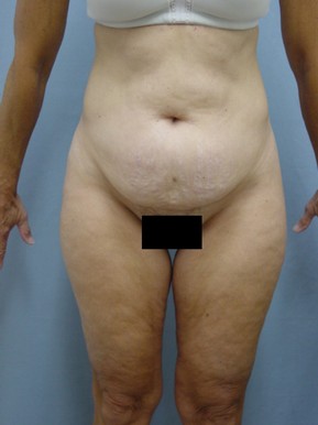 Tummy Tuck-Panniculectomy