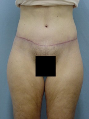 Tummy Tuck-Panniculectomy