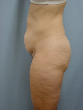 Tummy Tuck-Panniculectomy