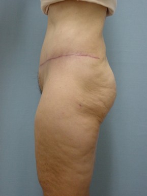 Tummy Tuck-Panniculectomy