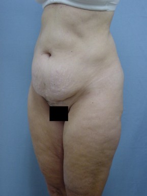 Tummy Tuck-Panniculectomy
