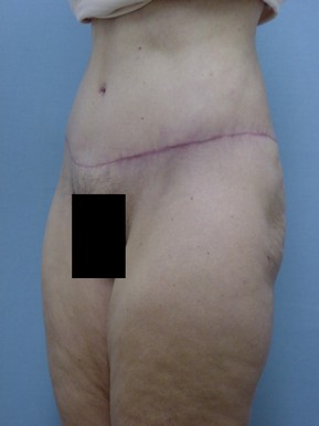 Tummy Tuck-Panniculectomy