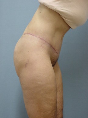 Tummy Tuck-Panniculectomy