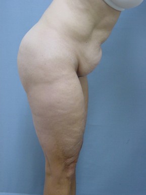 Tummy Tuck-Panniculectomy