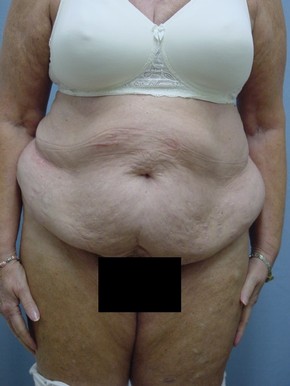 Tummy Tuck-Panniculectomy