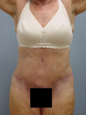 Tummy Tuck-Panniculectomy