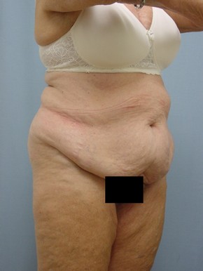 Tummy Tuck-Panniculectomy