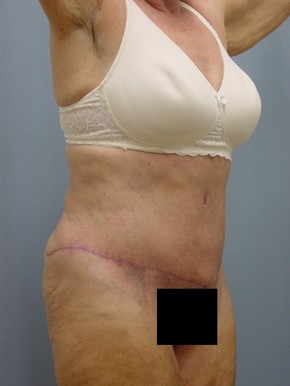 Tummy Tuck-Panniculectomy