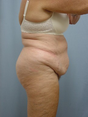 Tummy Tuck-Panniculectomy