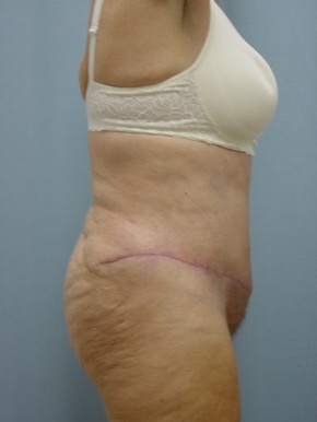 Tummy Tuck-Panniculectomy