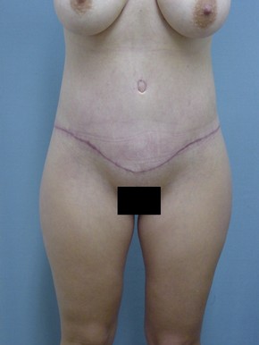 Tummy Tuck-Panniculectomy
