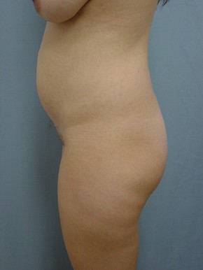 Tummy Tuck-Panniculectomy