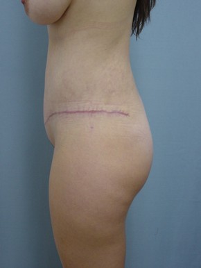 Tummy Tuck-Panniculectomy