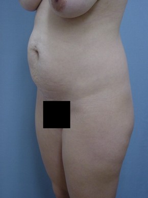 Tummy Tuck-Panniculectomy