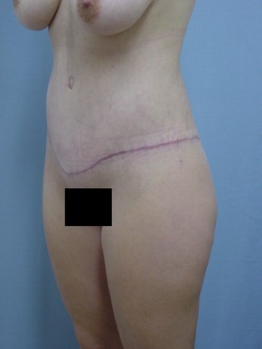 Tummy Tuck-Panniculectomy