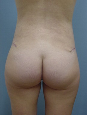 Tummy Tuck-Panniculectomy
