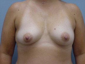 Asymmetry or Tuberous Breasts