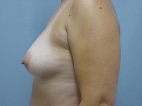 Asymmetry or Tuberous Breasts