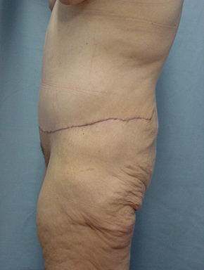 Tummy Tuck-Panniculectomy