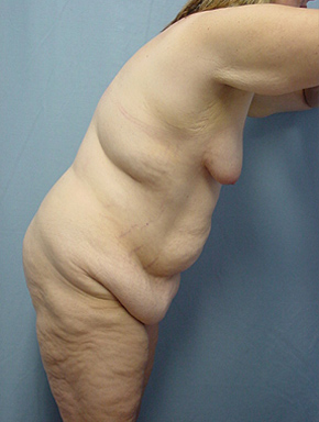 Tummy Tuck-Panniculectomy