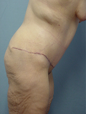 Tummy Tuck-Panniculectomy