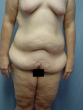Tummy Tuck-Panniculectomy