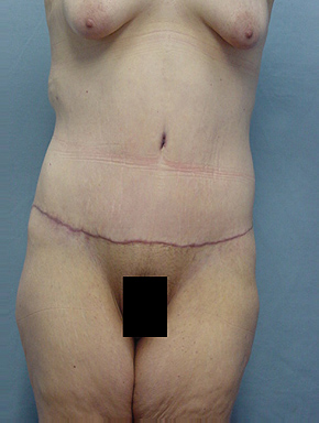 Tummy Tuck-Panniculectomy
