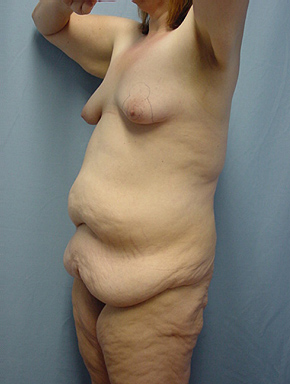 Tummy Tuck-Panniculectomy