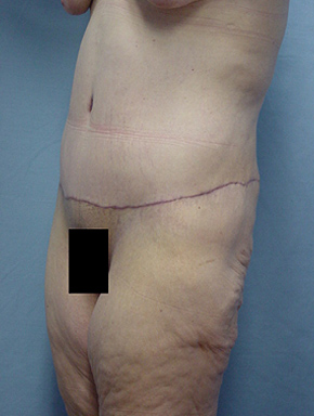 Tummy Tuck-Panniculectomy
