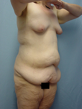 Tummy Tuck-Panniculectomy
