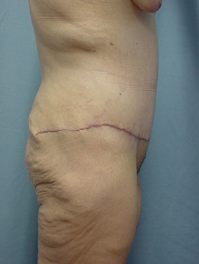 Tummy Tuck-Panniculectomy