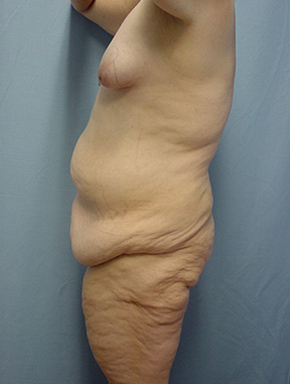 Tummy Tuck-Panniculectomy