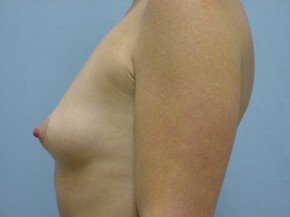 Asymmetry or Tuberous Breasts