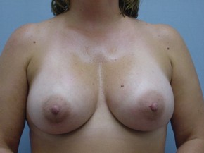 Breast Augmentation Gel