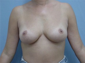 Breast Augmentation Saline