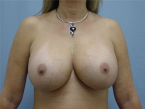 Breast Augmentation Saline