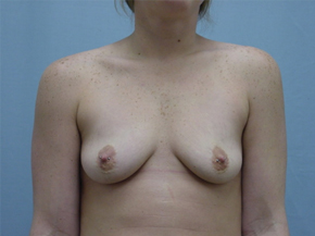 Breast Augmentation Saline