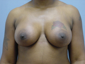 Breast Augmentation Saline